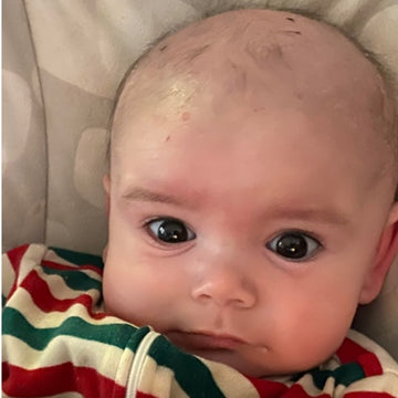 smiling infant showing that his skin is free from severe eczema