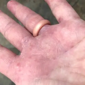 hand with cracked, dry skin before using goat milk products