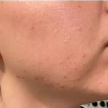 face skin showing results after sing tea tree products