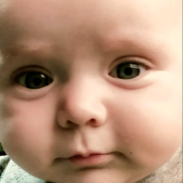 An infant boy no longer showing symptoms of impitigo
