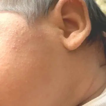 baby skin before using goat milk products, with texture and irritation