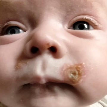 An infant boy with symptoms of impitigo