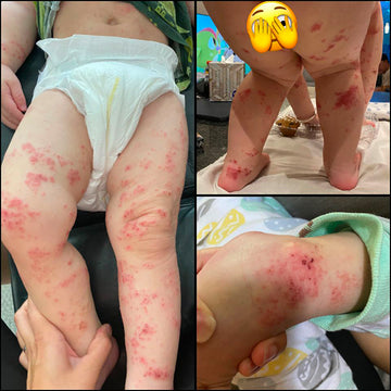 baby with extreme red rash covering body before using goat milk products