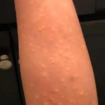 leg skin affected by eczema