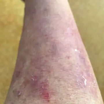 leg suffering from eczema
