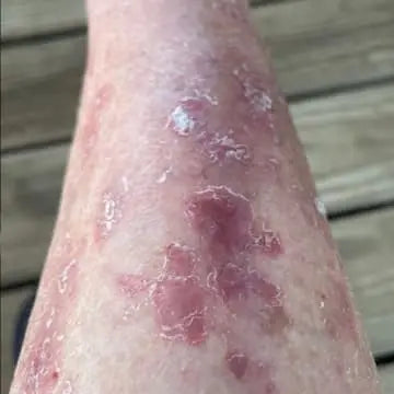 leg skin affected by extreme eczema