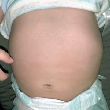 after photo of baby tummy cleared from irritation after using bend soap products