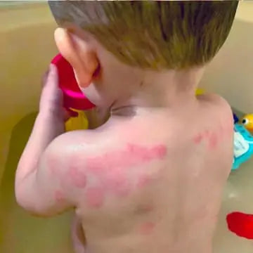 toddler skin with eczema
